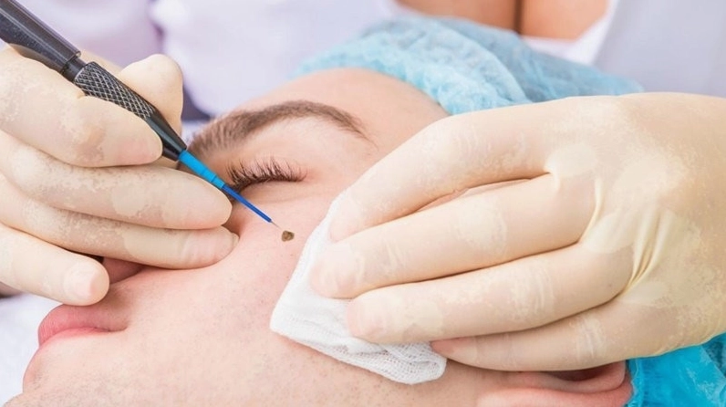 Các phương pháp tẩy nốt ruồi cần thực hiện đúng kỹ thuật