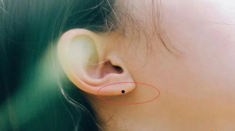 Nốt ruồi ở dái tai thường gắn liền với phúc khí