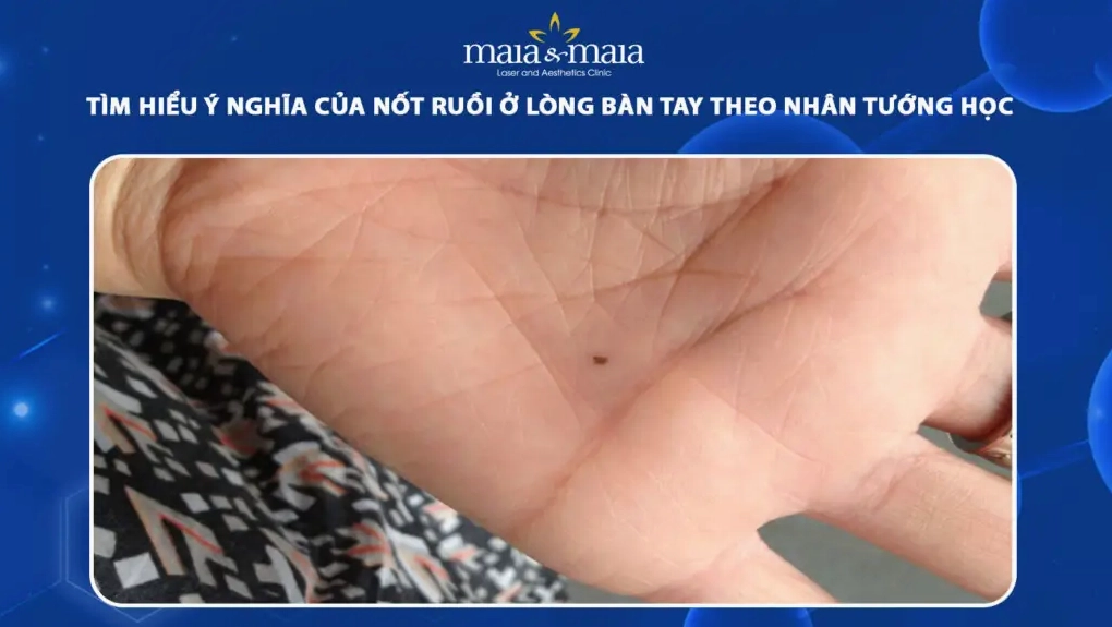 Nốt ruồi trong lòng bàn tay